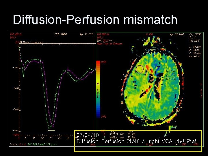 Diffusion-Perfusion mismatch 07/04/10 Diffusion-Perfusion 영상에서 right MCA 병변 관찰 