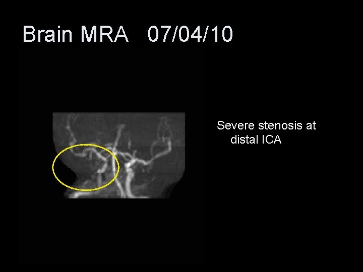 Brain MRA 07/04/10 Severe stenosis at distal ICA 