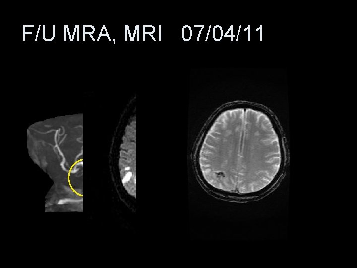 F/U MRA, MRI 07/04/11 