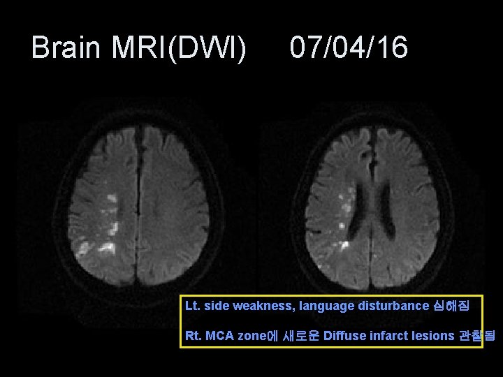 Brain MRI(DWI) 07/04/16 Lt. side weakness, language disturbance 심해짐 Rt. MCA zone에 새로운 Diffuse