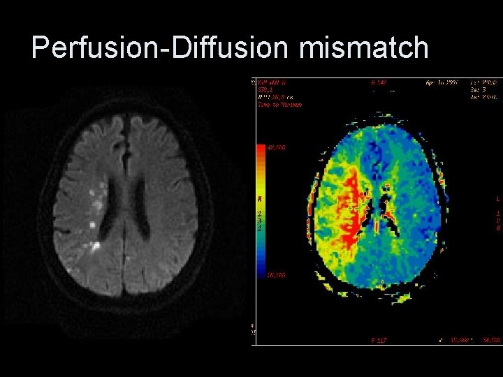 Perfusion-Diffusion mismatch 