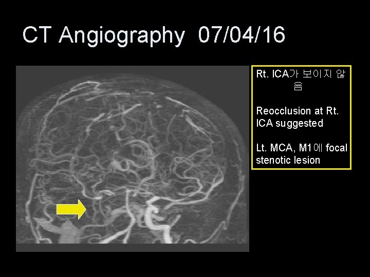 CT Angiography 07/04/16 Rt. ICA가 보이지 않 음 Reocclusion at Rt. ICA suggested Lt.