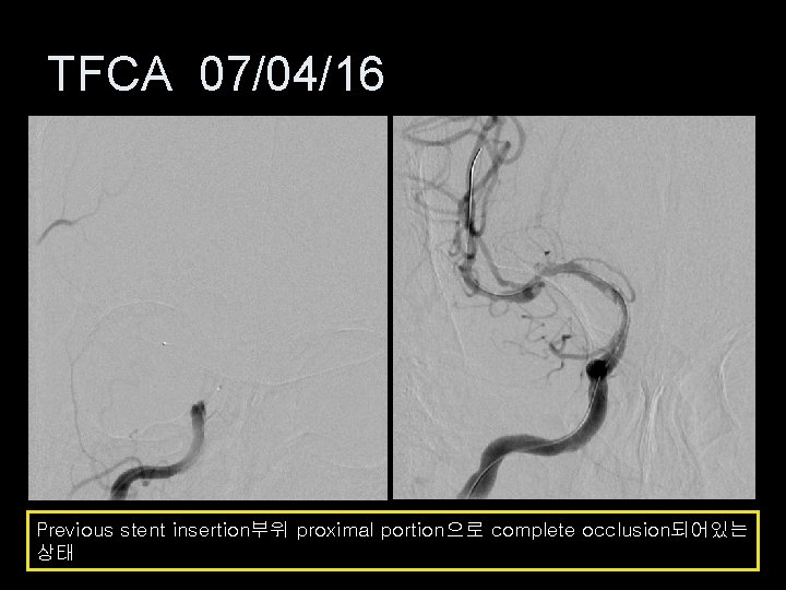 TFCA 07/04/16 Previous stent insertion부위 proximal portion으로 complete occlusion되어있는 상태 
