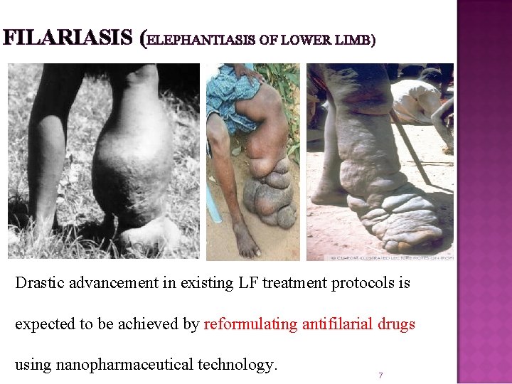 FILARIASIS (ELEPHANTIASIS OF LOWER LIMB) Drastic advancement in existing LF treatment protocols is expected