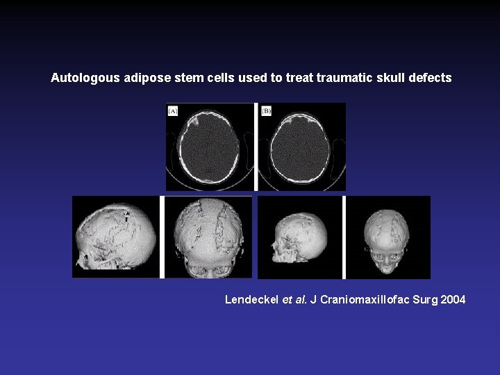 Autologous adipose stem cells used to treat traumatic skull defects Lendeckel et al. J