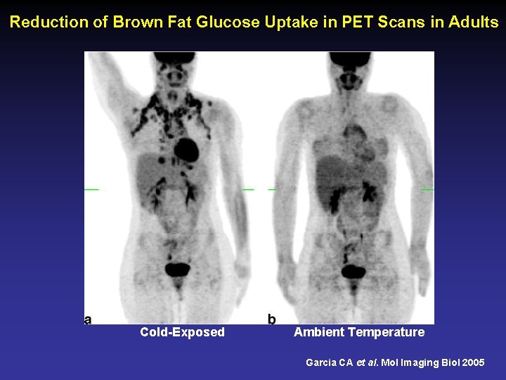 Reduction of Brown Fat Glucose Uptake in PET Scans in Adults Cold-Exposed Ambient Temperature