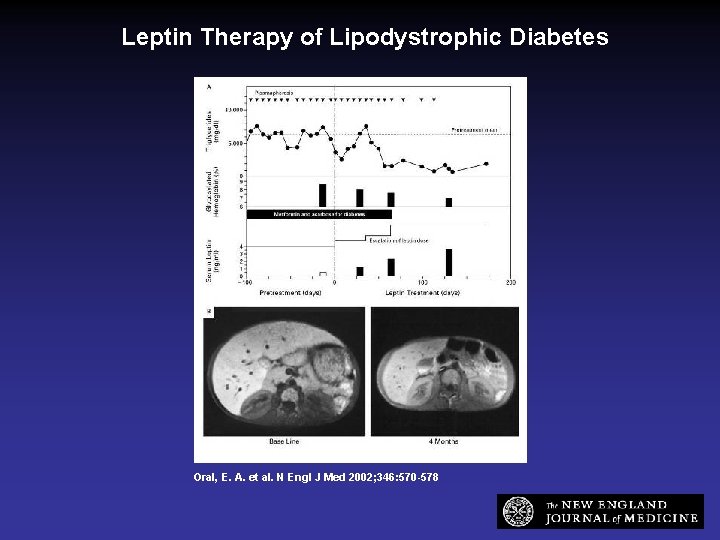 Leptin Therapy of Lipodystrophic Diabetes Oral, E. A. et al. N Engl J Med
