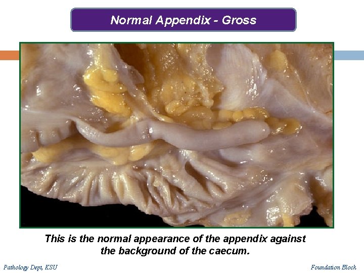 Normal Appendix - Gross This is the normal appearance of the appendix against the