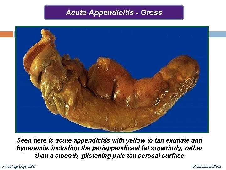 Acute Appendicitis - Gross Seen here is acute appendicitis with yellow to tan exudate