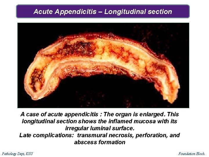 Acute Appendicitis – Longitudinal section A case of acute appendicitis : The organ is