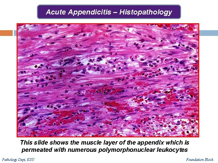 Acute Appendicitis – Histopathology This slide shows the muscle layer of the appendix which