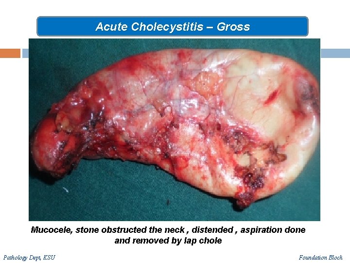 Acute Cholecystitis – Gross Mucocele, stone obstructed the neck , distended , aspiration done
