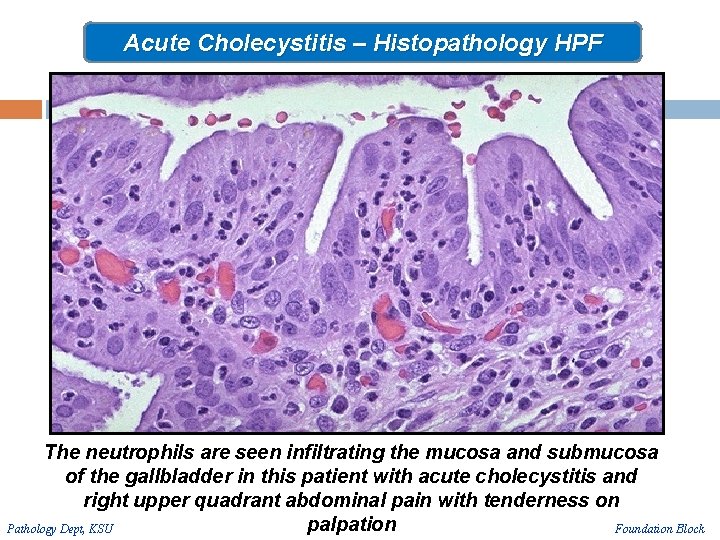 Acute Cholecystitis – Histopathology HPF The neutrophils are seen infiltrating the mucosa and submucosa