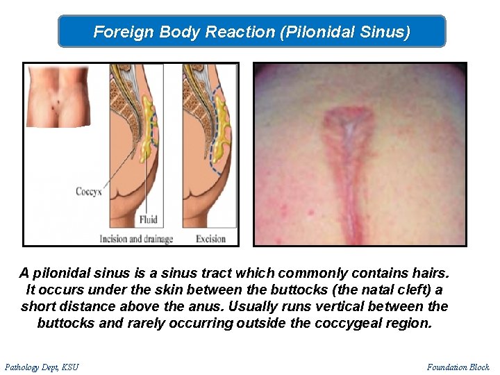 Foreign Body Reaction (Pilonidal Sinus) A pilonidal sinus is a sinus tract which commonly