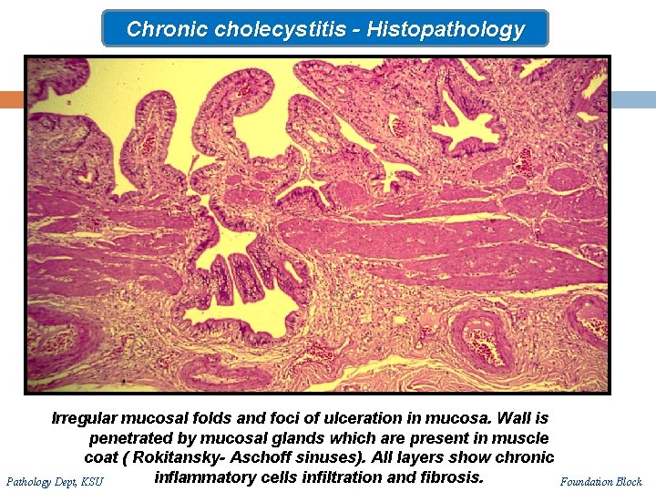 Chronic cholecystitis - Histopathology Irregular mucosal folds and foci of ulceration in mucosa. Wall