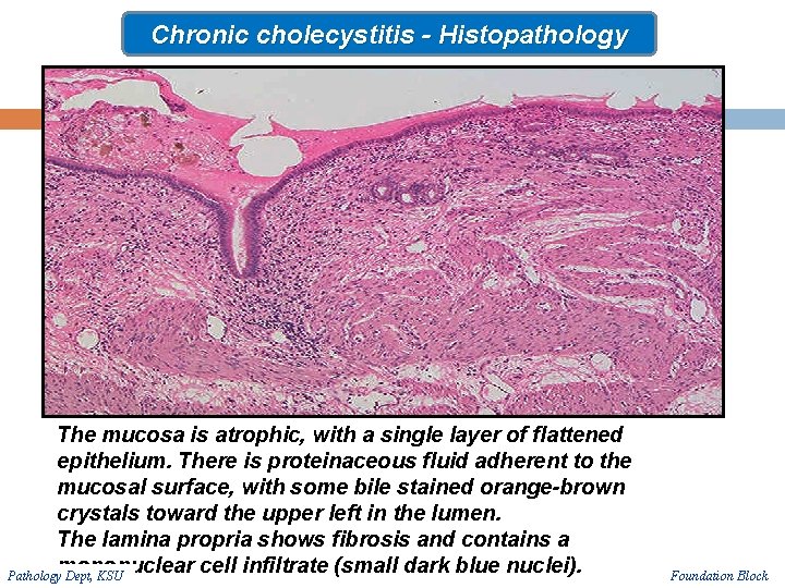 Chronic cholecystitis - Histopathology The mucosa is atrophic, with a single layer of flattened