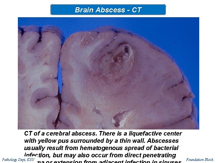 Brain Abscess - CT CT of a cerebral abscess. There is a liquefactive center