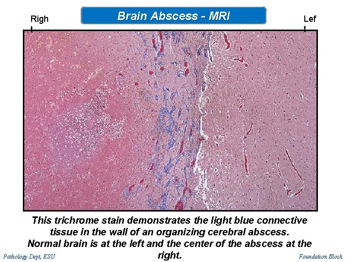 Righ t Brain Abscess - MRI Lef t This trichrome stain demonstrates the light