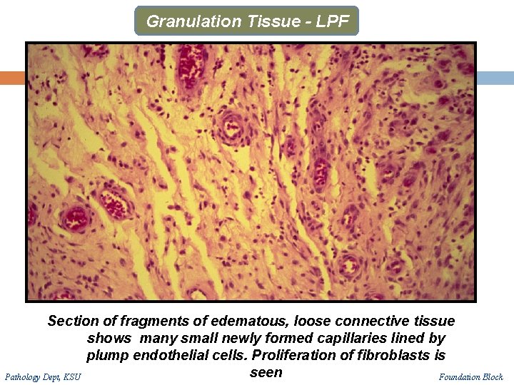 Granulation Tissue - LPF Section of fragments of edematous, loose connective tissue shows many