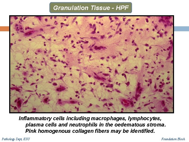 Granulation Tissue - HPF Inflammatory cells including macrophages, lymphocytes, plasma cells and neutrophils in