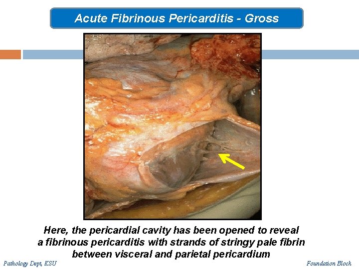 Acute Fibrinous Pericarditis - Gross Here, the pericardial cavity has been opened to reveal