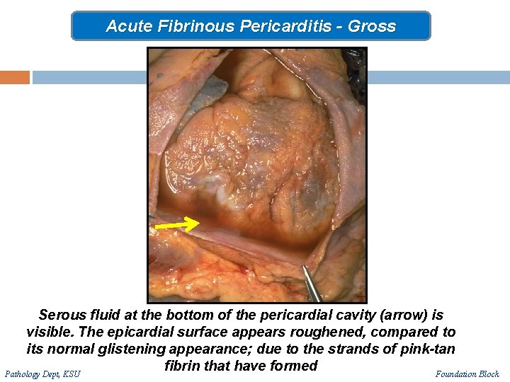 Acute Fibrinous Pericarditis - Gross Serous fluid at the bottom of the pericardial cavity