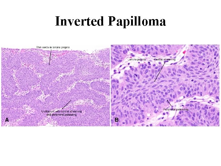 Inverted papilloma of urinary bladder - Despre Cancer Fain! - Inverted papilloma ureter pathology
