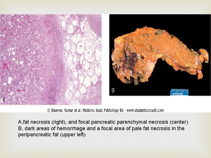  A, fat necrosis (right), and focal pancreatic parenchymal necrosis (center) B, dark areas