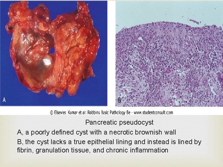  Pancreatic pseudocyst A, a poorly defined cyst with a necrotic brownish wall B,