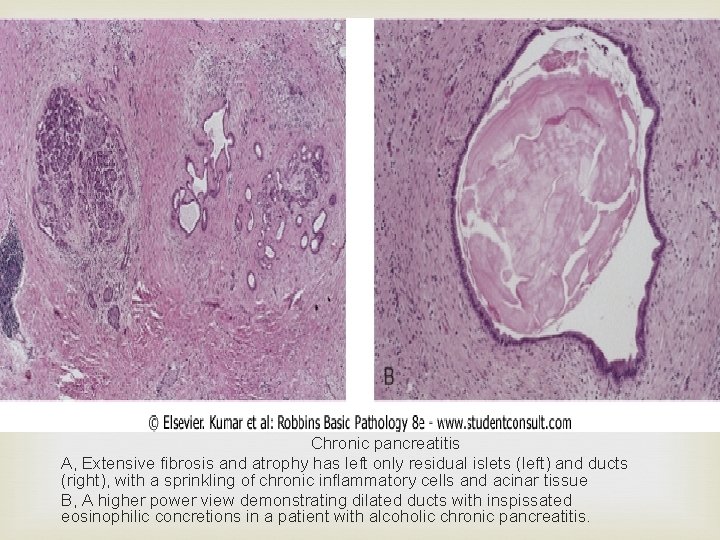  Chronic pancreatitis A, Extensive fibrosis and atrophy has left only residual islets (left)