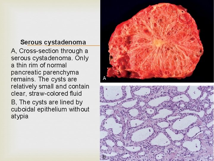 Serous cystadenoma A, Cross-section through a serous cystadenoma. Only a thin rim of normal