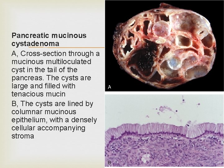 Pancreatic mucinous cystadenoma A, Cross-section through a mucinous multiloculated cyst in the tail of