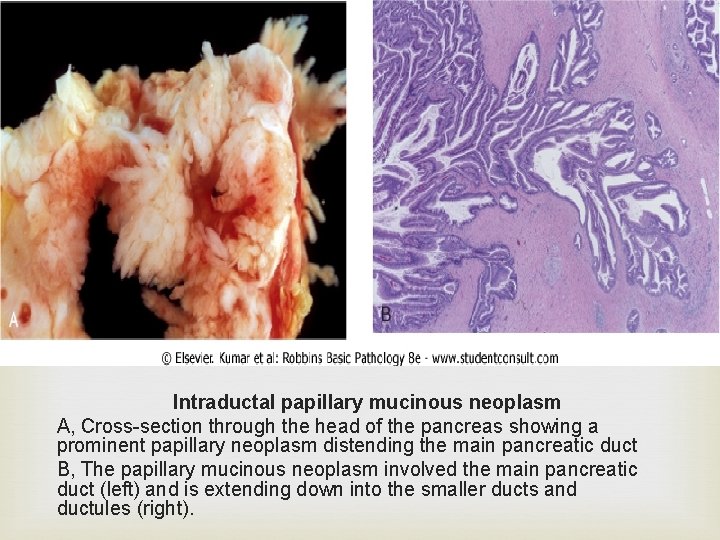 Intraductal papillary mucinous neoplasm A, Cross-section through the head of the pancreas showing