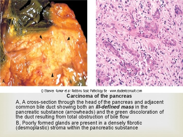  Carcinoma of the pancreas A, A cross-section through the head of the pancreas