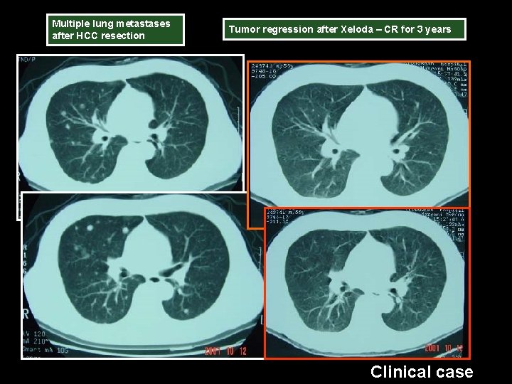 Multiple lung metastases after HCC resection Tumor regression after Xeloda – CR for 3