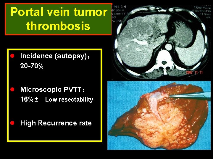 Portal vein tumor thrombosis l Incidence (autopsy)： 20 -70% l Microscopic PVTT： 16%± Low