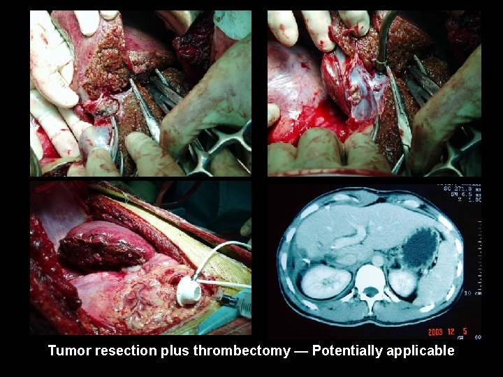 Tumor resection plus thrombectomy — Potentially applicable 