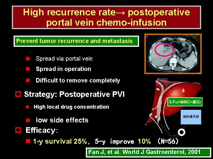 High recurrence rate→ postoperative portal vein chemo-infusion Prevent tumor recurrence and metastasis n Spread