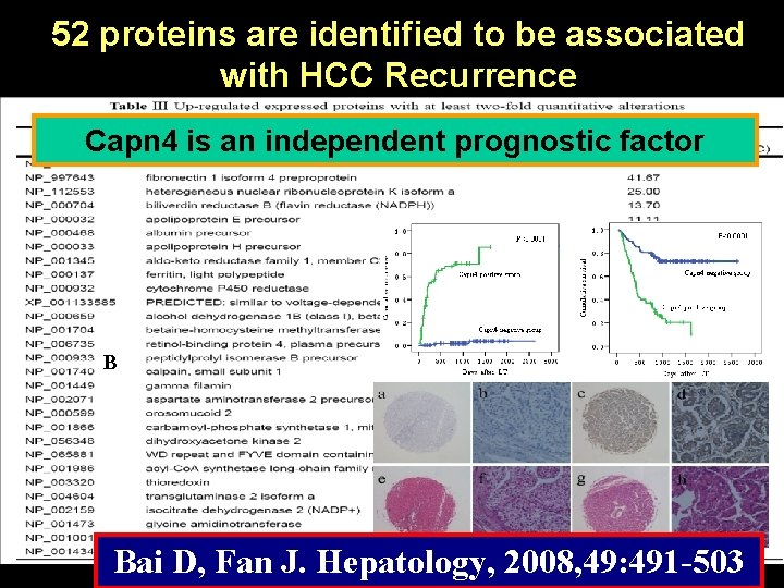 52 proteins are identified to be associated with HCC Recurrence Capn 4 is an