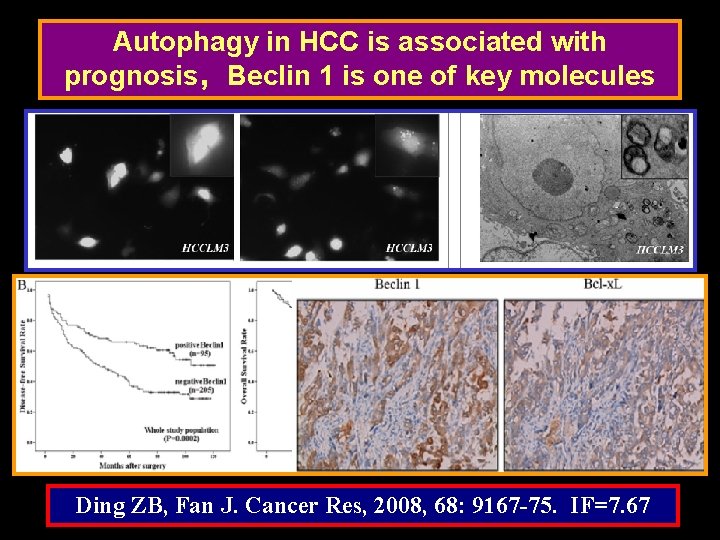 Autophagy in HCC is associated with prognosis，Beclin 1 is one of key molecules Ding