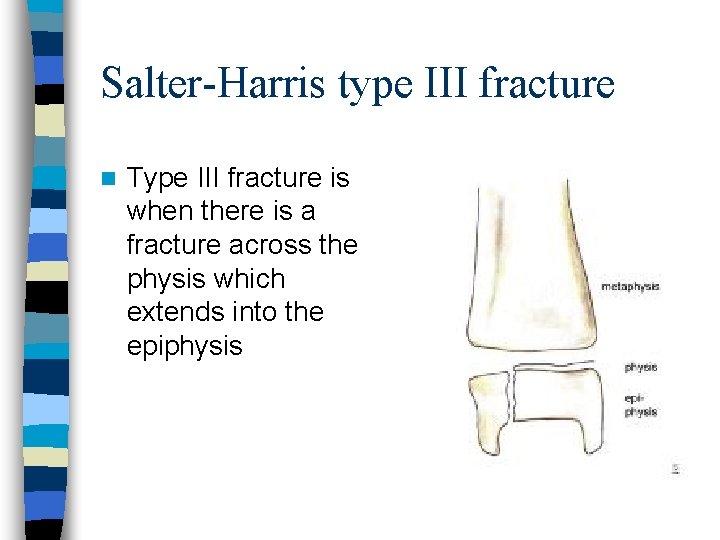 Salter-Harris type III fracture n Type III fracture is when there is a fracture