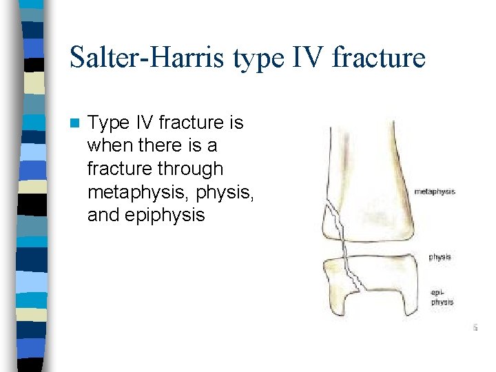 Salter-Harris type IV fracture n Type IV fracture is when there is a fracture