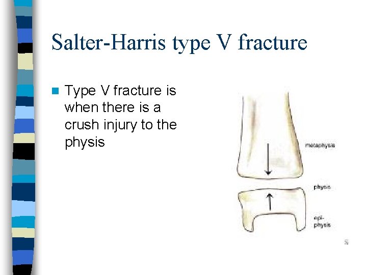 Salter-Harris type V fracture n Type V fracture is when there is a crush