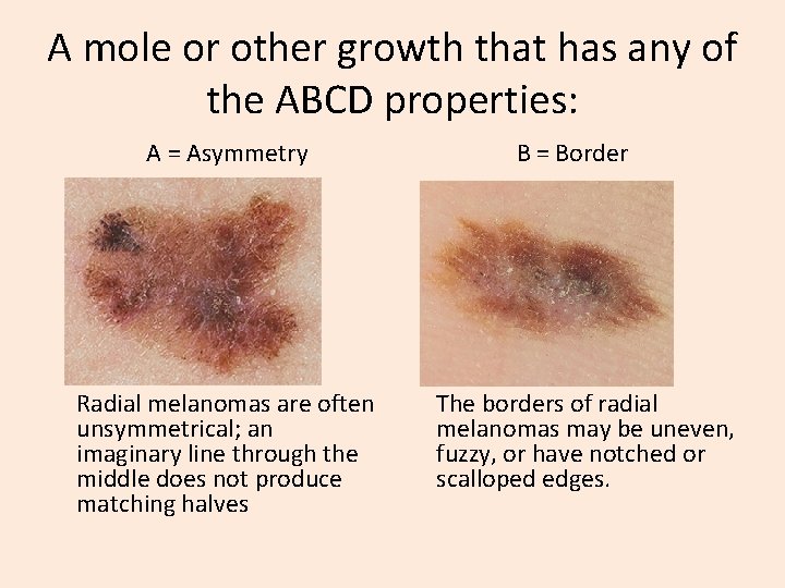 A mole or other growth that has any of the ABCD properties: A = A mole or other growth that has any of the ABCD properties: A =