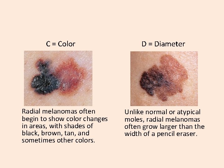 C = Color Radial melanomas often begin to show color changes in areas, with C = Color Radial melanomas often begin to show color changes in areas, with