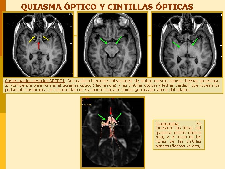 QUIASMA ÓPTICO Y CINTILLAS ÓPTICAS Cortes axiales seriados SPGRT 1: Se visualiza la porción