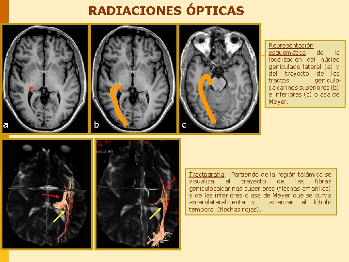 RADIACIONES ÓPTICAS Representación esquemática de la localización del núcleo geniculado lateral (a) y del