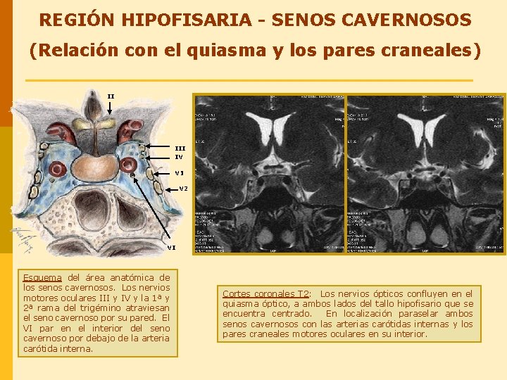 REGIÓN HIPOFISARIA - SENOS CAVERNOSOS (Relación con el quiasma y los pares craneales) II