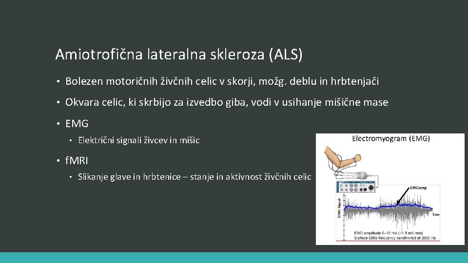 Amiotrofična lateralna skleroza (ALS) • Bolezen motoričnih živčnih celic v skorji, možg. deblu in