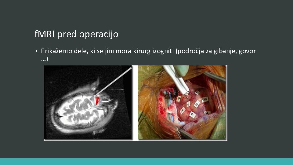 f. MRI pred operacijo • Prikažemo dele, ki se jim mora kirurg izogniti (področja